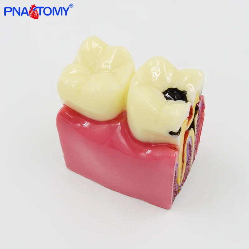 

Dental Materials Lab Teeth Model 6 Times Caries Comparation Study Models For Dentist Studying and Researching