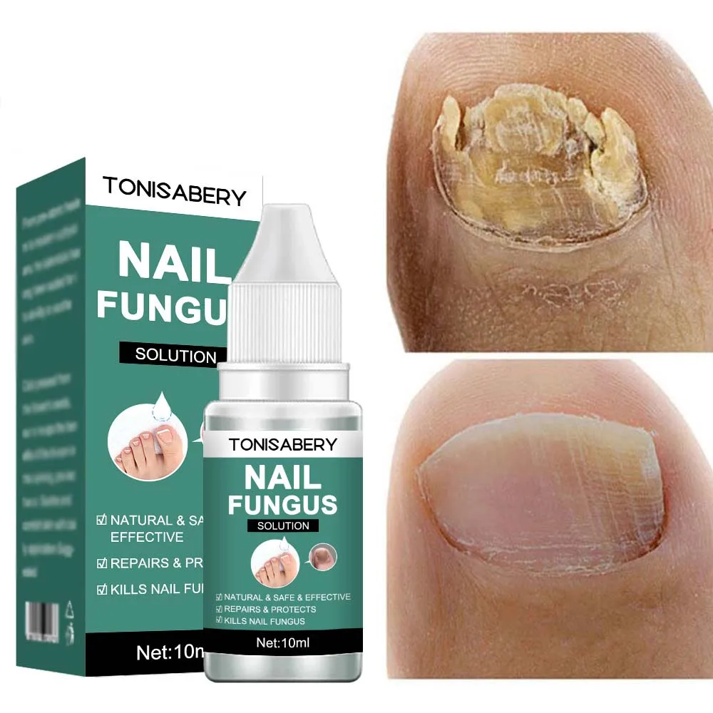 

Nail Fungal Treatment Cuticle oil Feet Care Repair Serum Nail Remedy Fungus Removal Gel Anti Infection Paronychia Onychomycosis