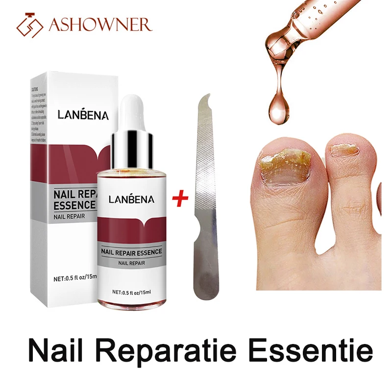

Nail Reparatie Essentie Serum Anti Schimmel Nagel Behandeling Verwijderen Onychomycose Voedende Fleuren Hand Voet Tene