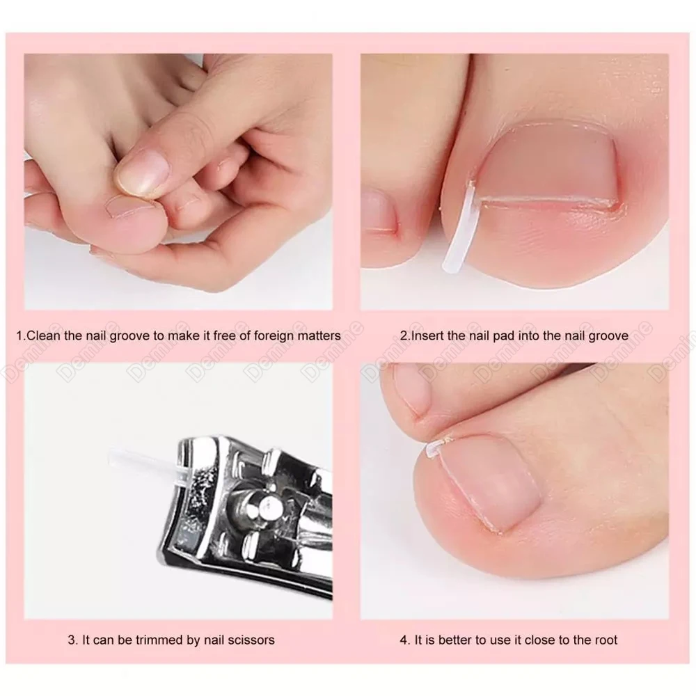 

10pcs Ingrown Toenail Straightening Stickers Toe Nail Corrector Treatment Devices Foot Care Patch Professional Pedicure Tools