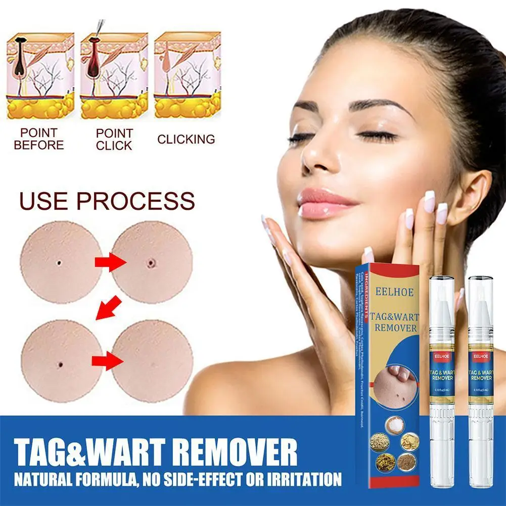 

Skin Tag Remover Pen Wart Removal Liquid Against Mole Warts Remove Tool Papillomas Corn Chinese Herbal Treatment Plaster 3ml