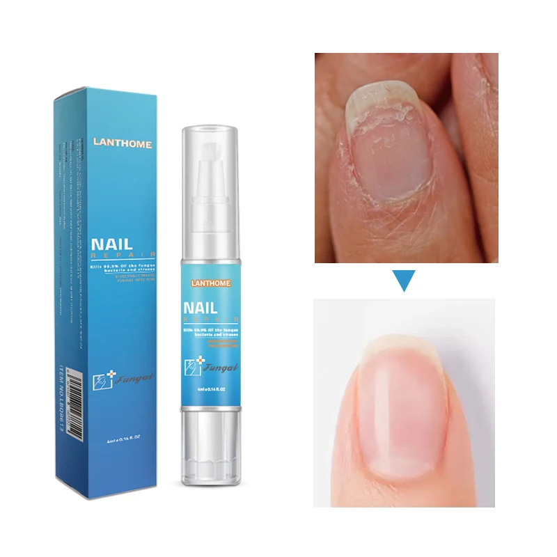 

Cuticle Oil for Foot Toe Nail Nourishment Pen Cuticle Revitalizer Fungal Treatment Repair Nail Onychomycosis Nail Nourish Bright