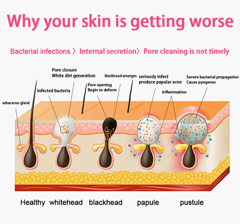 Blackhead Remover Blackheads Remover Pimple Acne Vulgaris Removal Vacuum Suction Removing Blackheads Pore Cleaner Pro Tool USB