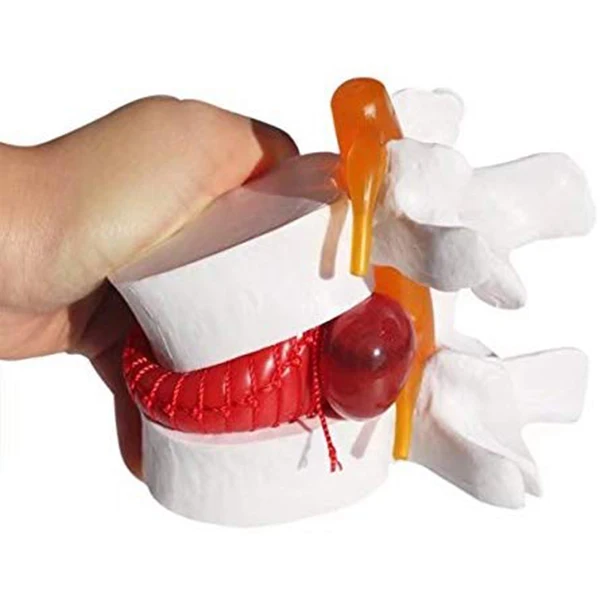 

1pc Anatomical Lumbar Disc Herniation Lumbar Spine Model White Color UY8