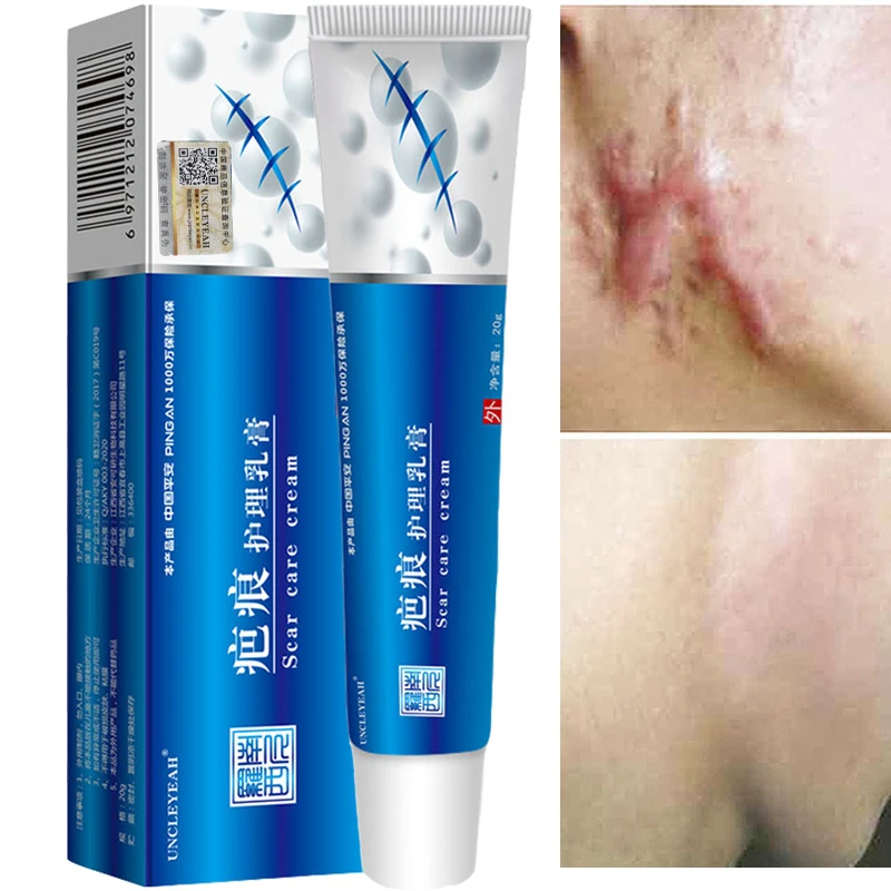 Acne Scar Removal Cream Pimples Stretch Marks Face Gel Remove Acne Smoothing Whitening Body Skin Care Pigmentation Corrector