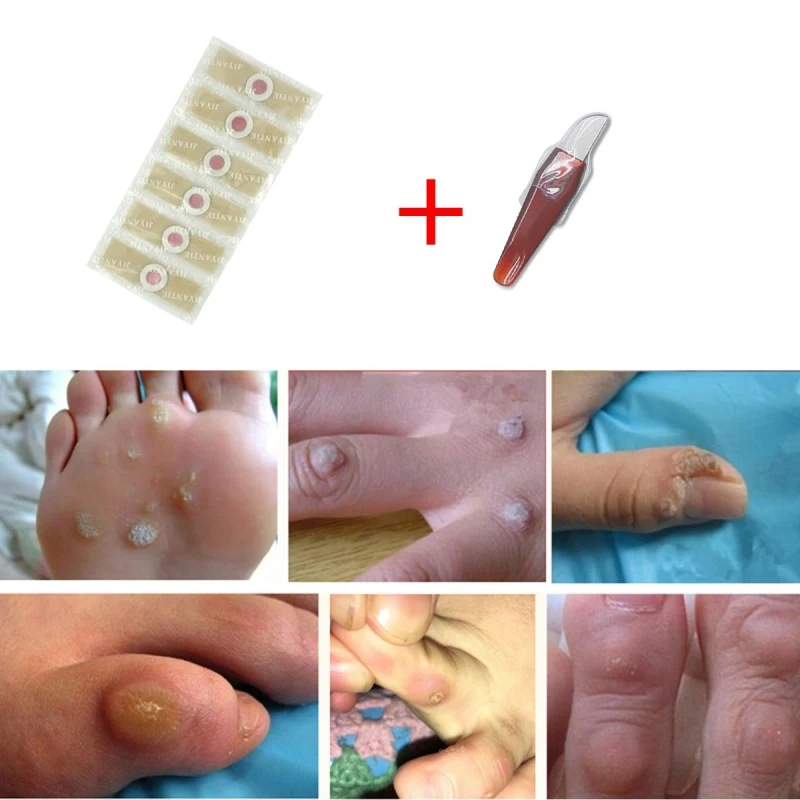 6Pcs /12pcs Wart Removal Patch Painlessly Remove Feet Callus Cutins Corn Remover Pads Soften Skin Cutin Care | Красота и здоровье