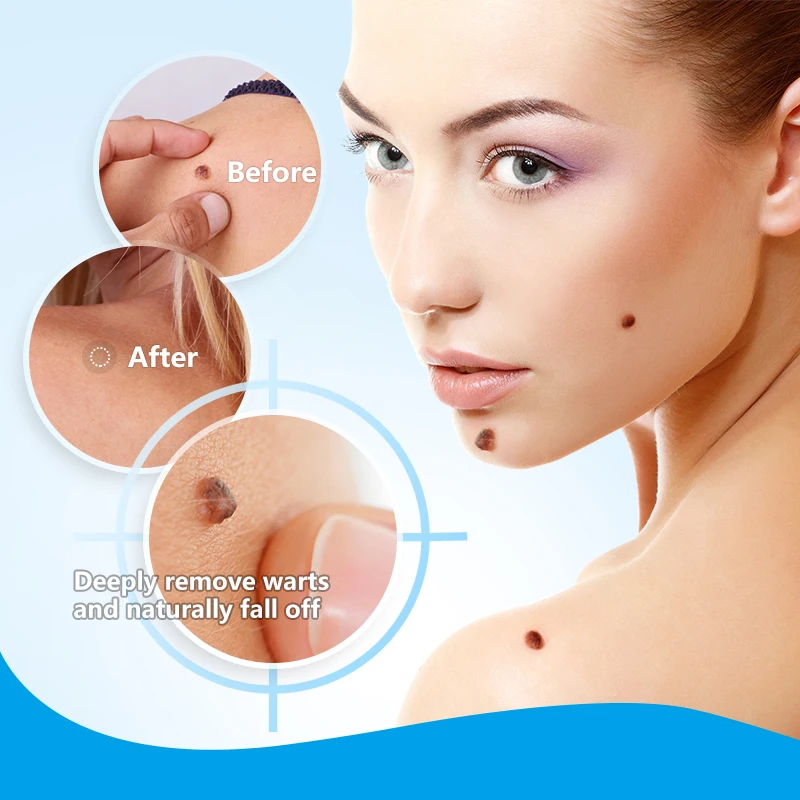 

1 box of wart treatment papilloma wart removal cream skin label mole removal anti-wart remedy cream