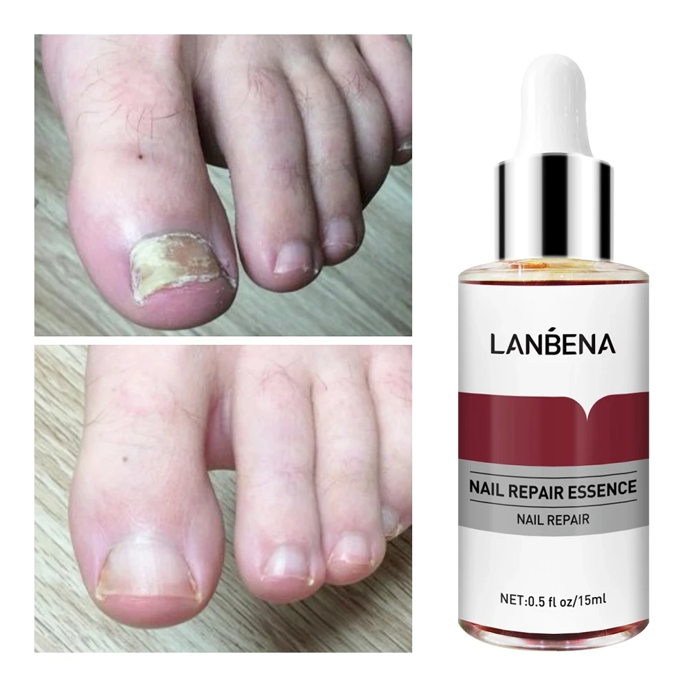 

LANBENA Fungal Nail Treatment Essence Serum Care Repair Foot Nail Fungus Removal Gel Anti Infection Paronychia Onychomycosis
