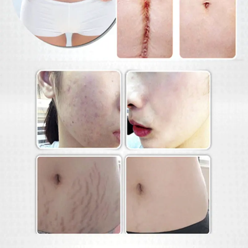 Эфирное Масло для массажа лаванды масло удаления шрамов беременных женщин