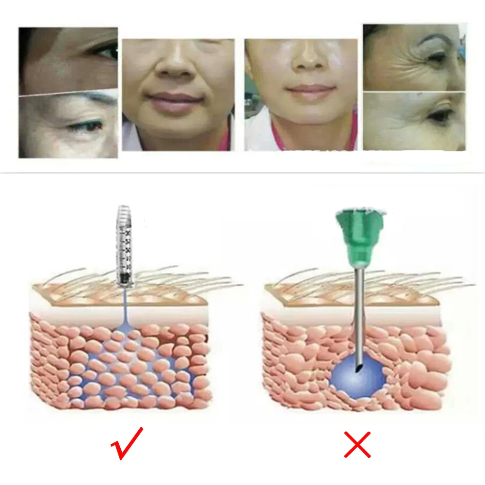 Гиалуроновая ручка для инъекций распылитель микро омолаживание и увлажнение