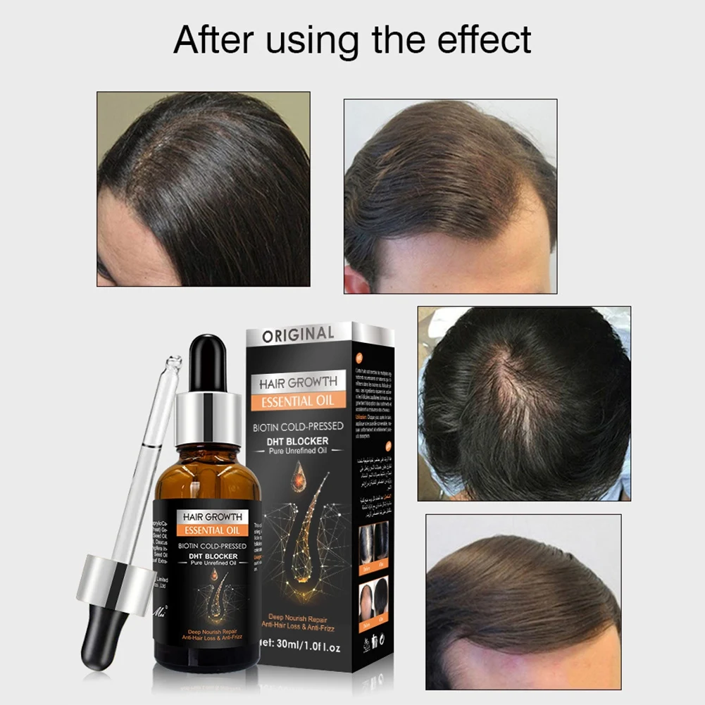 

30ml Ginger Hair Growth Essential Oils Dense Hair Loss Treatment Liquid Essence Health Care Hair Growth Serum