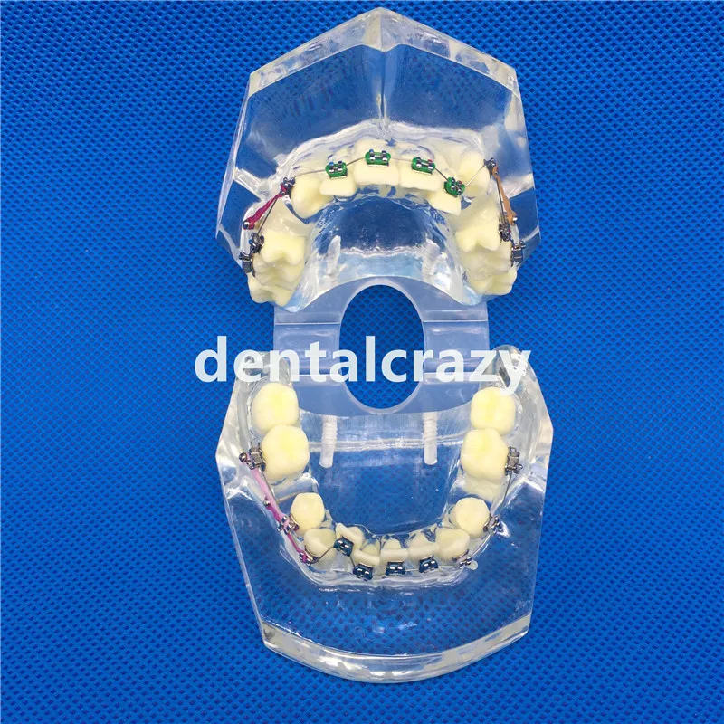 Стоматологическая модель зубов прозрачная ремонта патологического имплантата