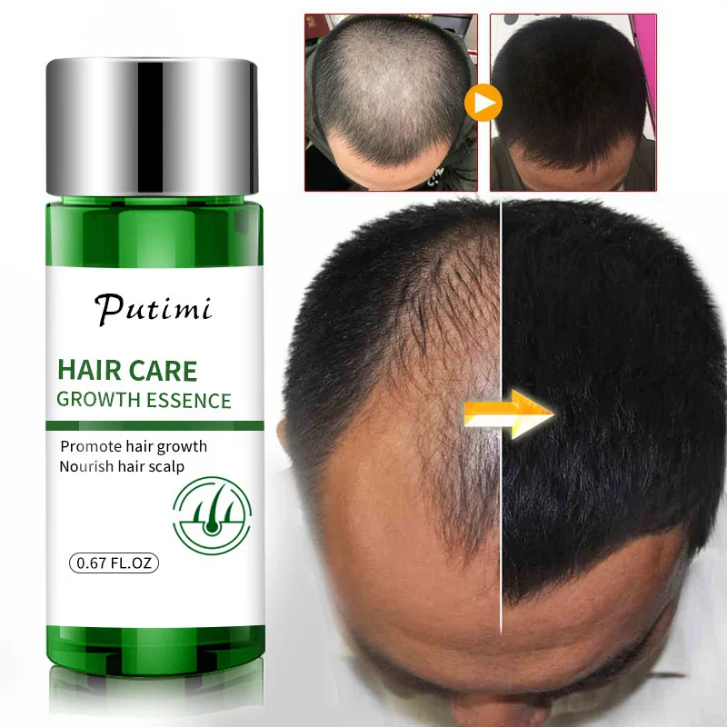 

Ginger Hair Growth Essential Oils Anti Hair Loss Serum Promote Hair Regrowth Essence Prevent Baldness Repair Damaged Hair Care