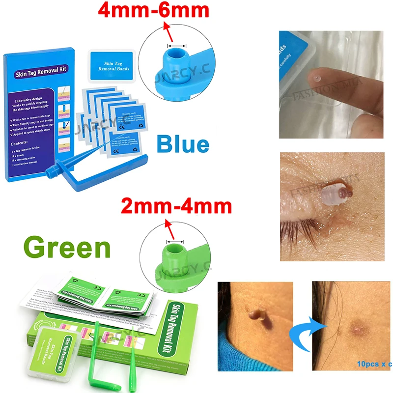 Бирки кожи удаления комплект папилломы кожей устраняющий недостатки очищающий