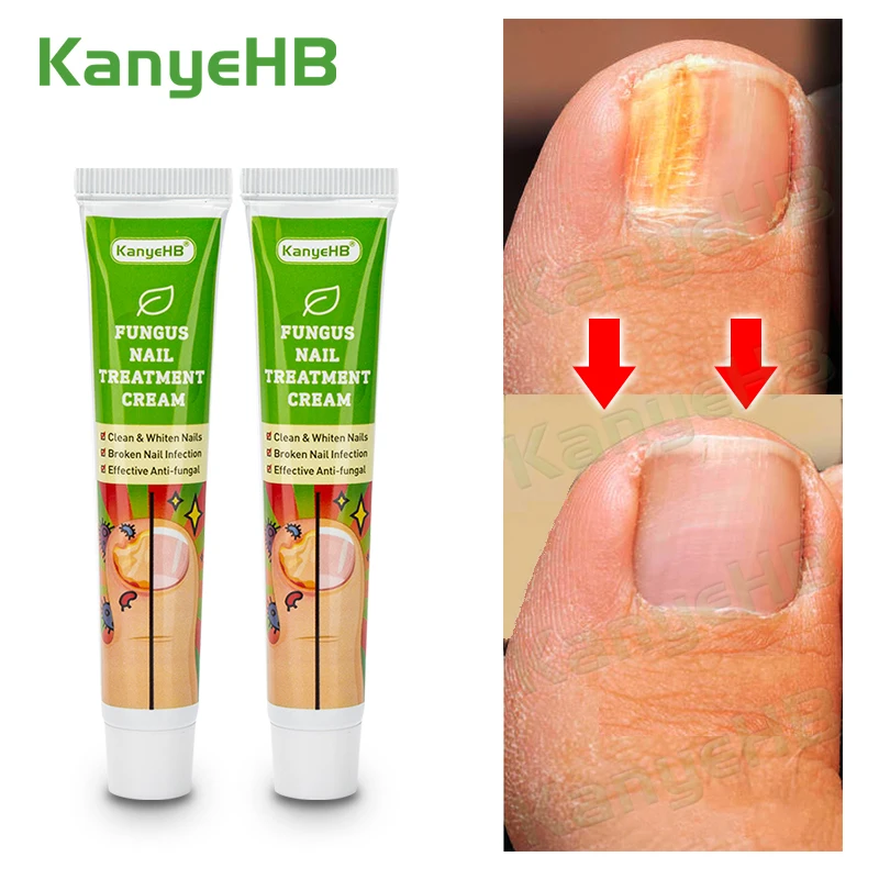 

2pcs Nail Fungus Removal Cream Onychomycosis Fungal Nail Treatment Paronychia Anti Infection Toe Fungal Nail Care Ointment A652