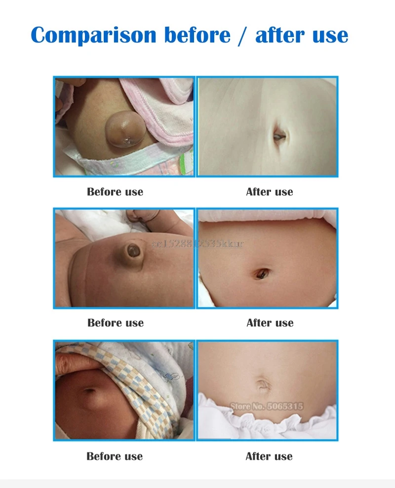 Продукты высокого качества бесплатная доставка детская пупочная грыжа с