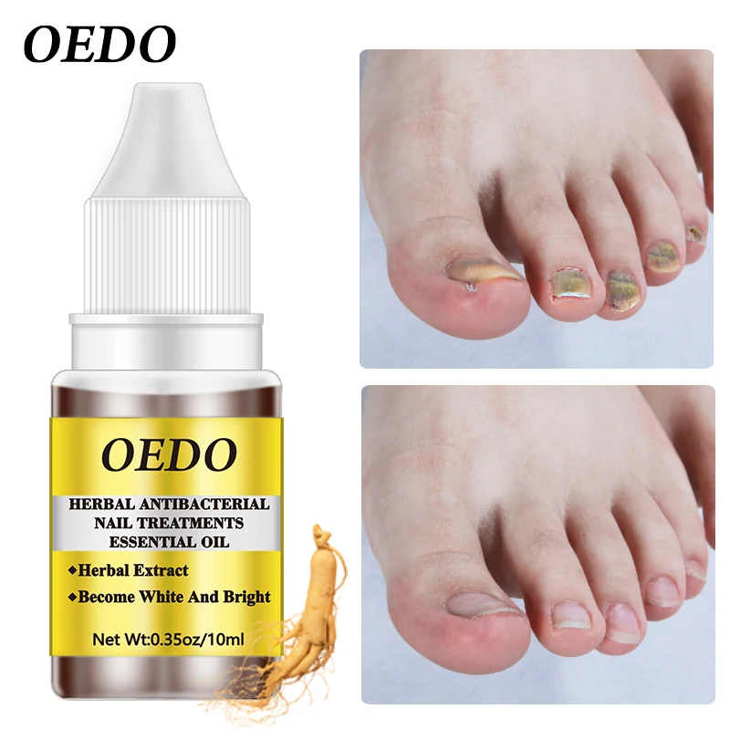 Травяные антигрибковые эфирные масла для лечения Ногтей экстракт китайской