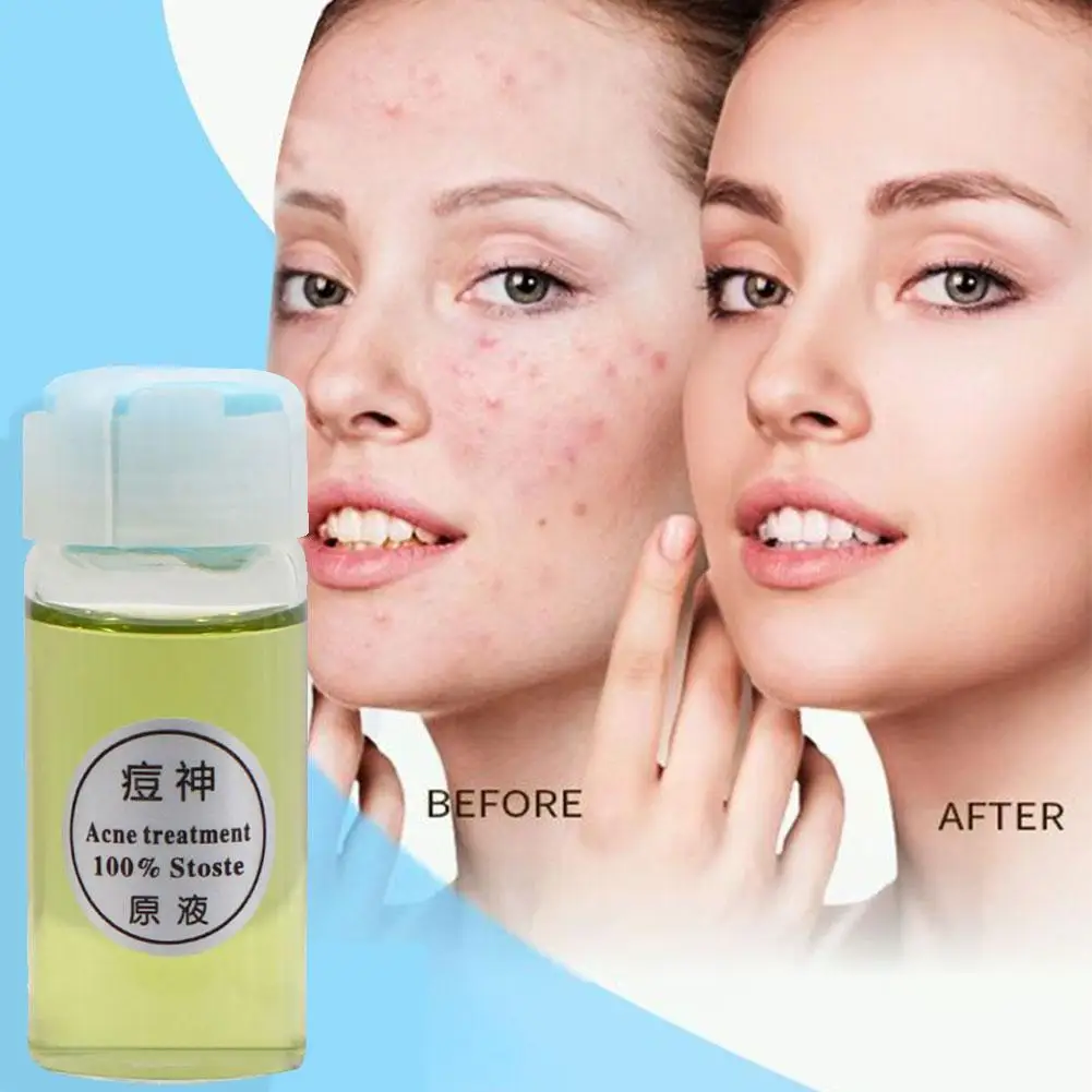 

10ml Herbals Acne N Pimple Face Oil Cream Spots BlackHead Blemish Treatment Korean Skin Care Acne Treatment Essence Face Care