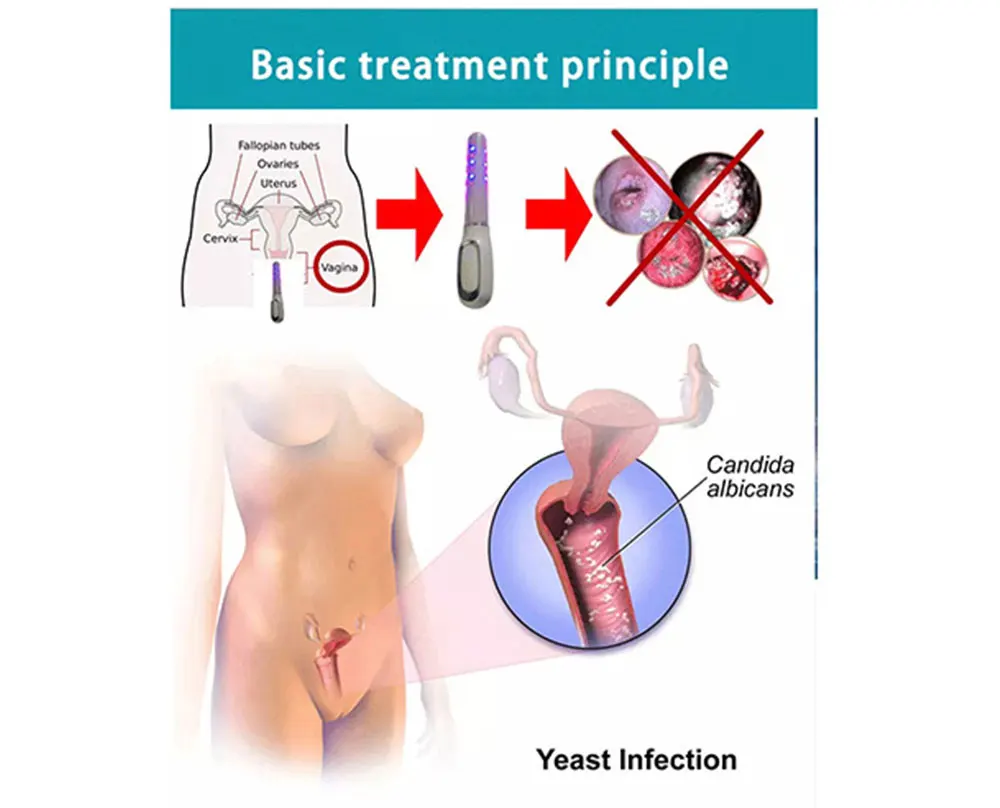 ATANG Hot Sale Health and Beauty Products Women Household Vaginal Tightening Product Laser Therapy Device Anti-inflammatory