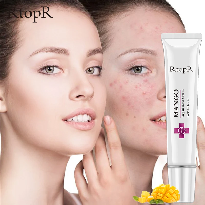 Лечение акне уход за кожей лица крем для удаления черных точек ремонта масляного