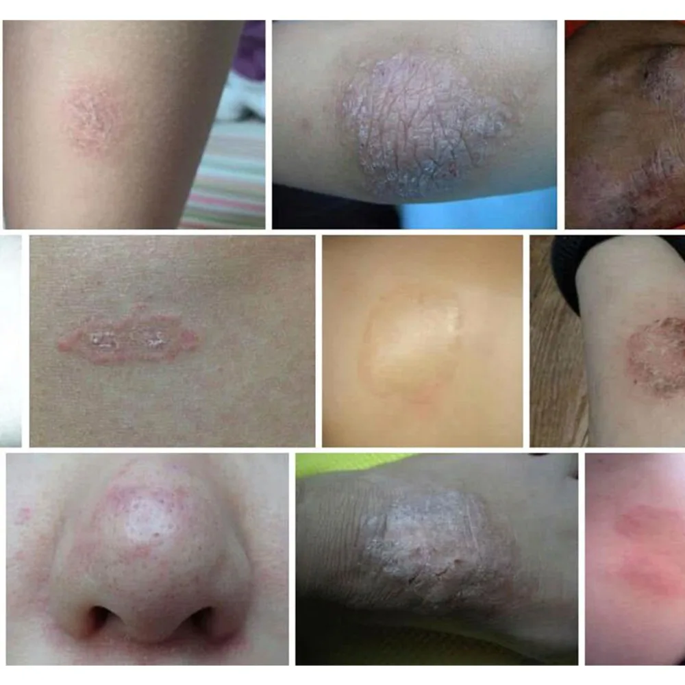 

Natural Chinese Medicine Herbal Anti Bacteria Cream Psoriasis Eczema Ointment Treatment