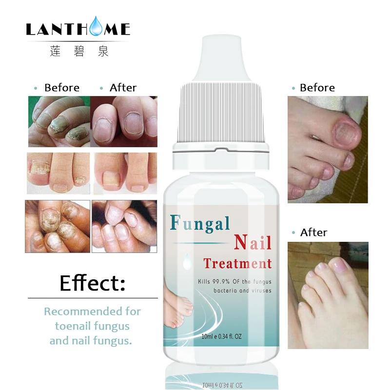 

Fungal Nail Treatment Serum Onychomycosis Paronychia Anti-Fungal Nail Infection 10ml Herbal Toe Fungus Foot Repair Essence Care