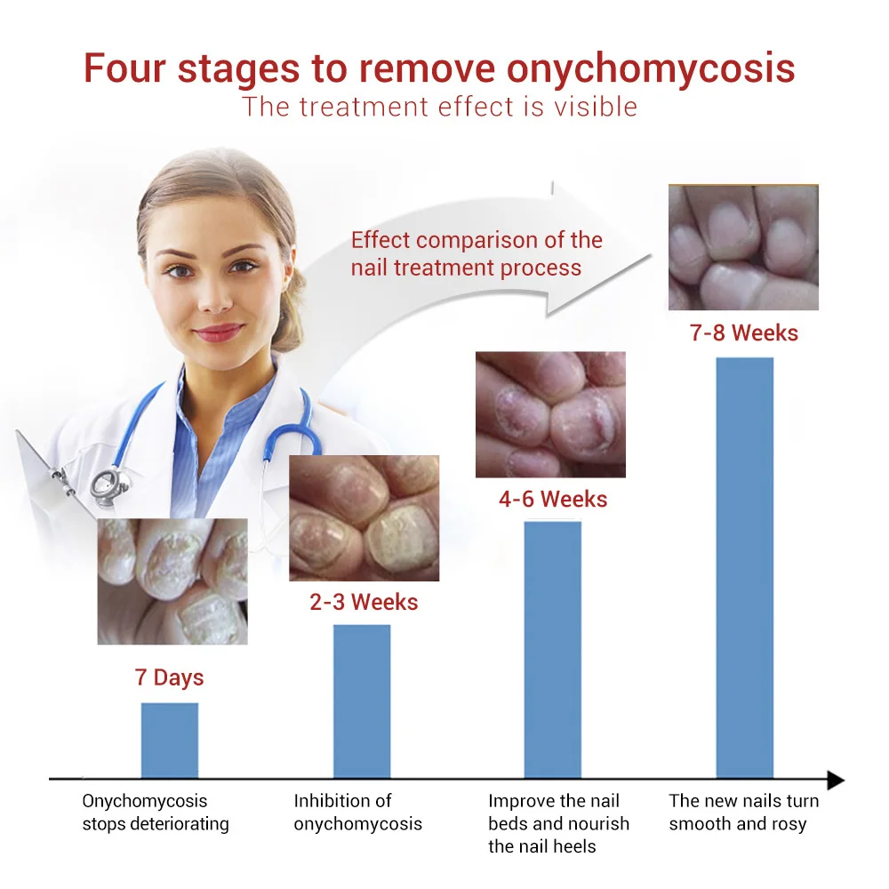 

Nail Care Essence Fungal Nail Repair Remove Onychomycosis Toes Athlete's Foot Hand And Foot Skin Care2PCS