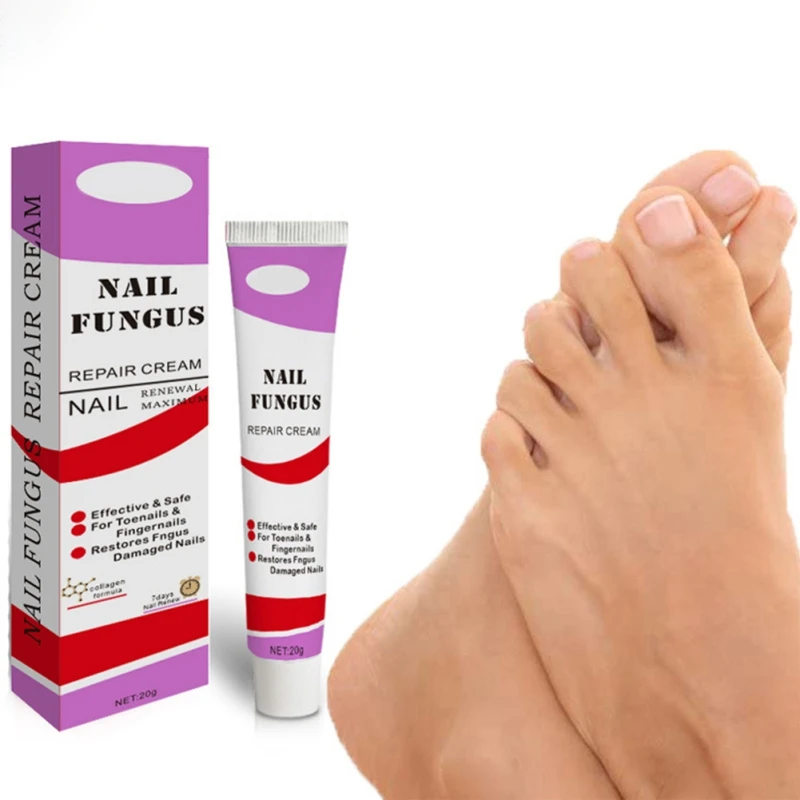 

Новый 20 г грибковое Лечение ногтей Уход за ногами Крем для удаления грибка ногтей гель против инфекции пароникья онихомикоз