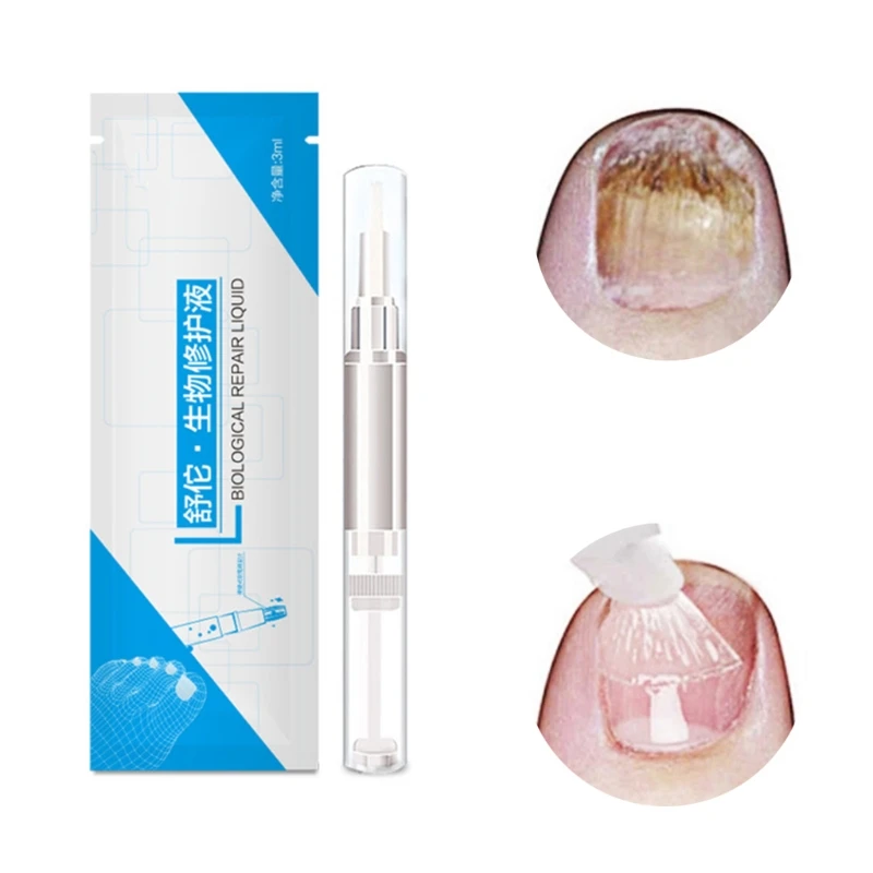 

2021 New 3ml Nail Fungus Treatment Liquid Anti Fungal Finger Toe Nails Care Solution