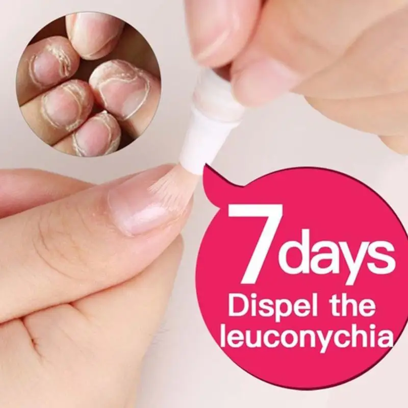 

3ml Nail Treatment Pen Onychomycosis Paronychia Anti Infection Herbal Nail Fungal Chinese Fungus Toe Treatment Nail Massage U8J8