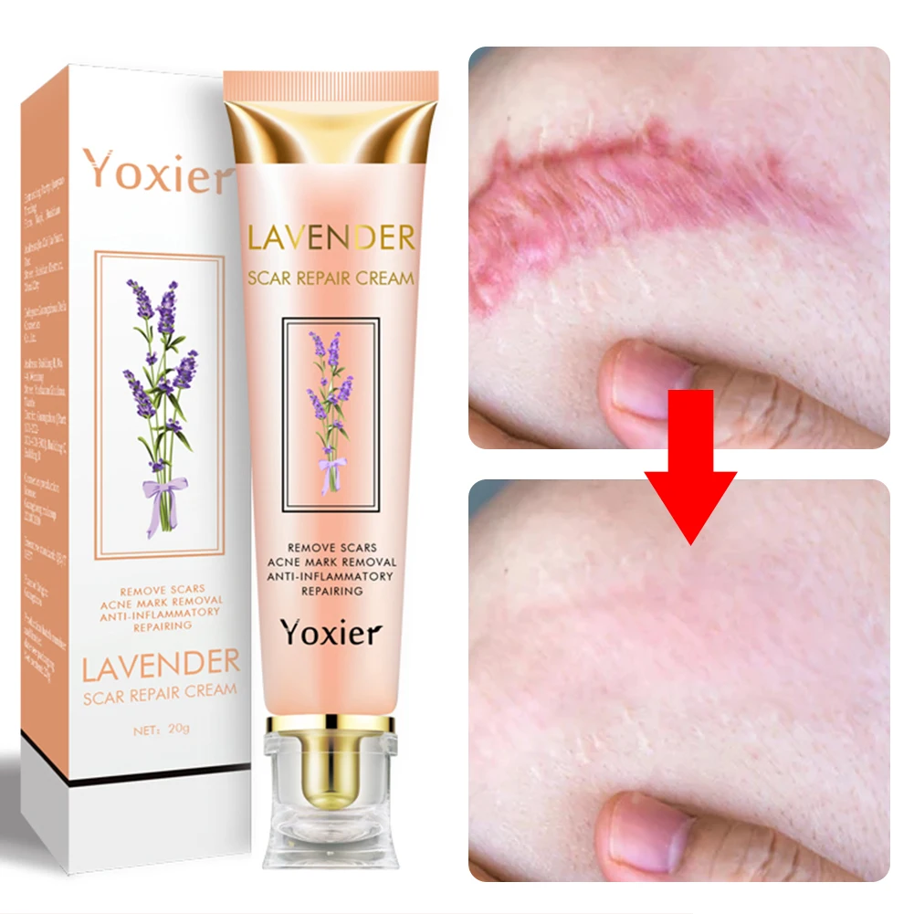 Крем для удаления шрамов растяжек следов от акне крем лечения ожогов гладкой и