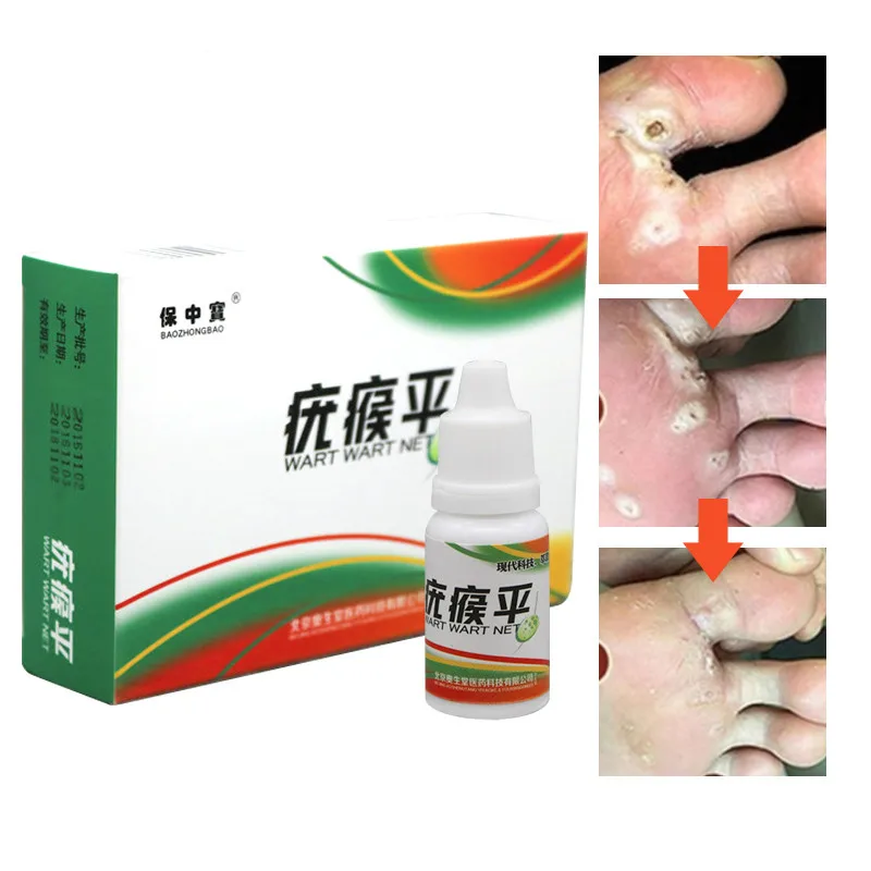 10 мл/20 мл средство для удаления кожных тегов 12 часов мозолей и гениталий