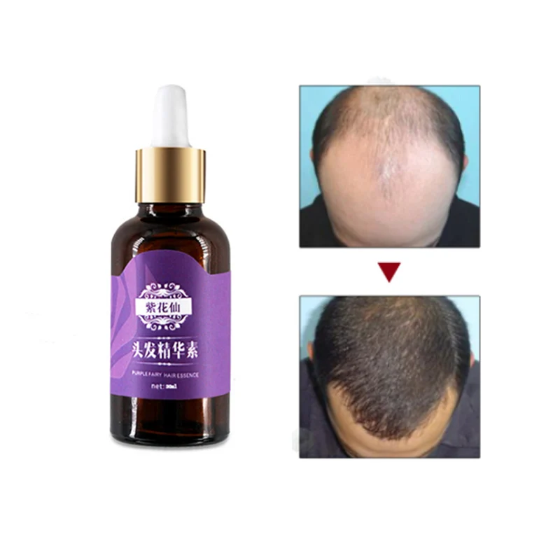 Средство от выпадения волос натуральное | Красота и здоровье