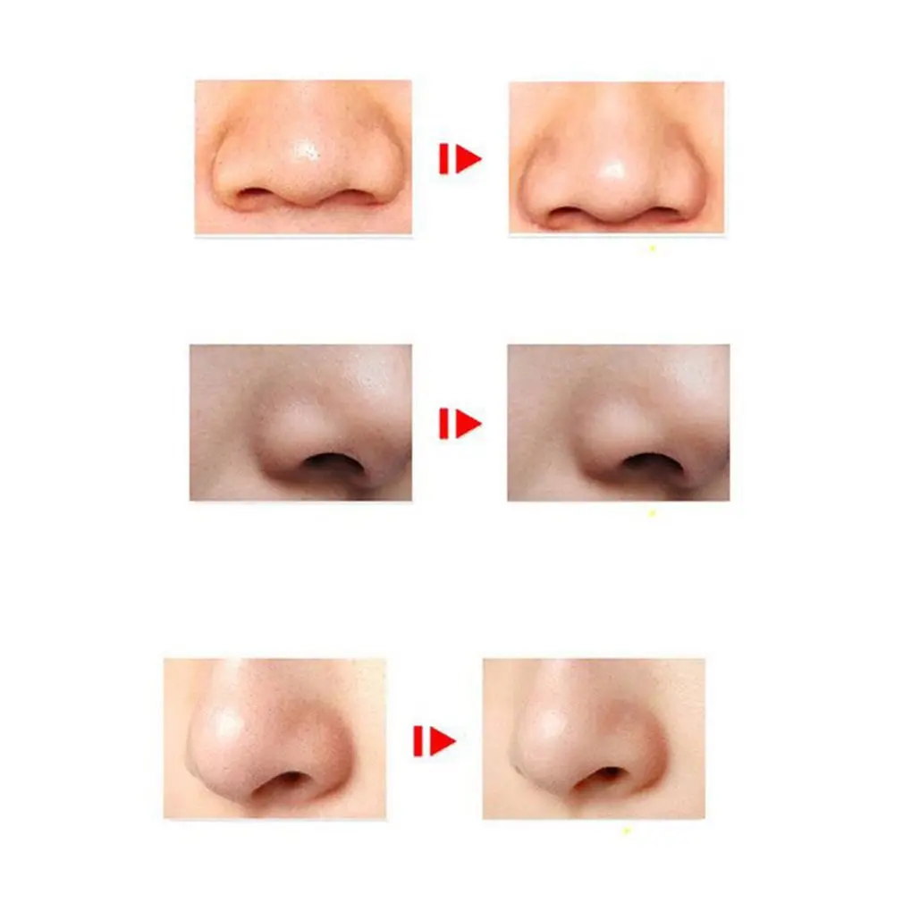 Портативный пылесос для удаления угрей профессиональный очиститель пор лица