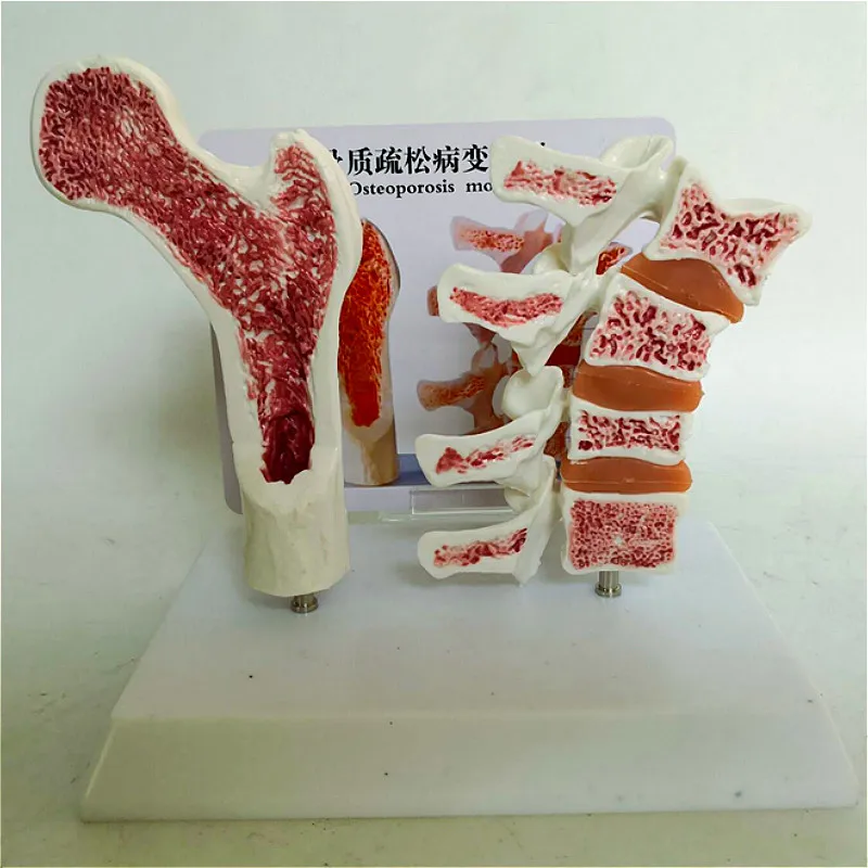 

human osteoporosis Comparative model Femoral head Skeletons vertebra anatomical lesions Explanation model