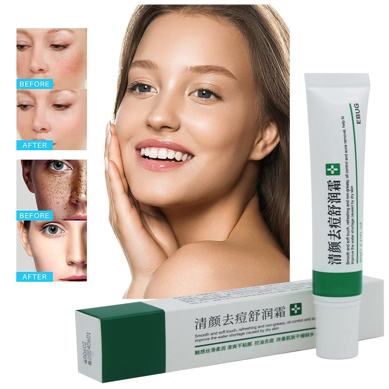 

Whitening Cream/acne Cream Moisturizing Brightening Cream Effectively Removes Acne Facial Care Skin Care Mask for Face Fashion