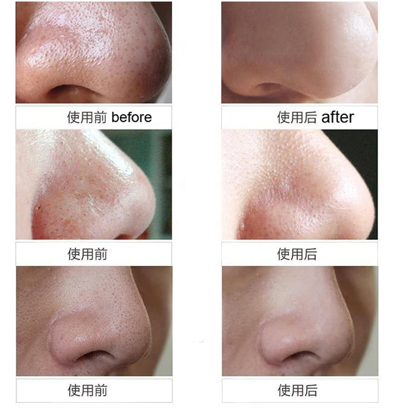 Microdermabrasion Diamond Peeling Device Facial Pore Cleaner Blackhead Removal Skin Peel Dermabrasion Face Care | Красота и здоровье