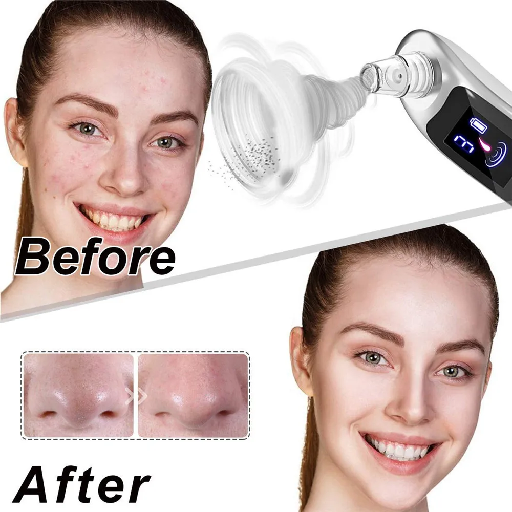 Очищение лица носа акне черная точка экстрактор для удаления черных точек