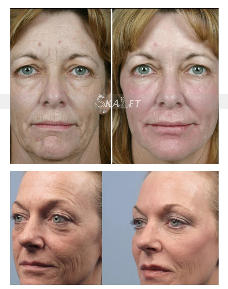 Цена по прейскуранту завода лучшие продажи анти-старения кожи подтяжки морщин