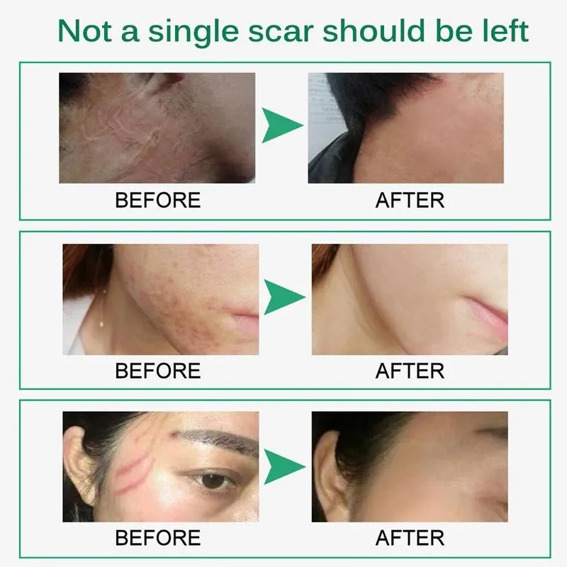 

Skin Rebound Scarless Cream Scar Removal Cream Face Cream For Face Acne Scar Stretch Marks Skin Repair Face Cream