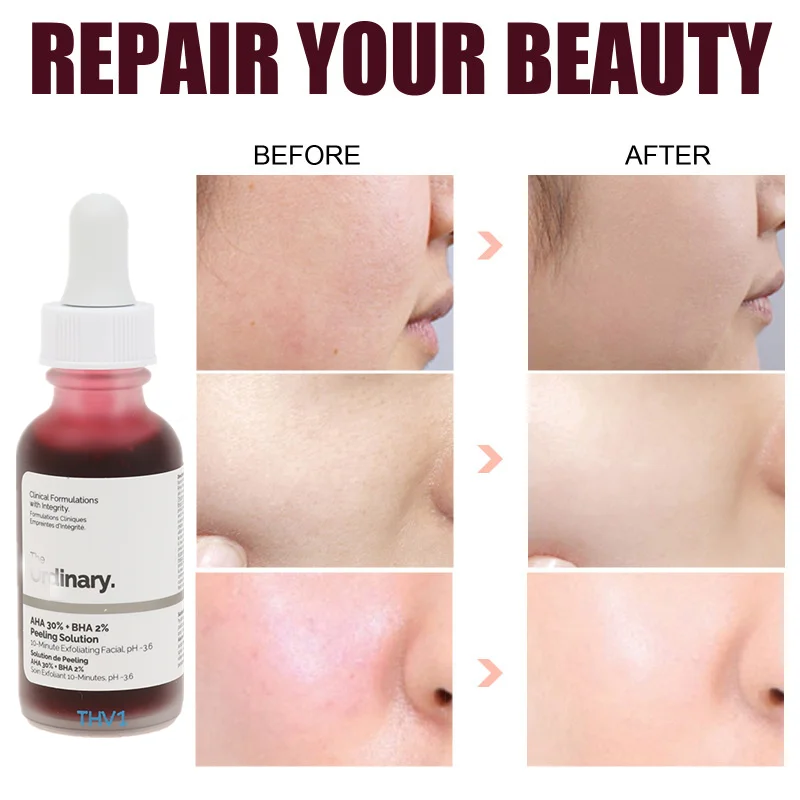 

Face Makeup Peeling Solution AHA 30% + BHA 2% Acne Removing Serum Exfoliating Brighten Anti-Aging Skin Care