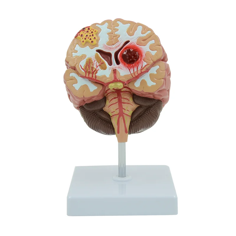 

Diseased Brain Model Stroke Brain Anatomy Demonstration Nervous System Human Internal Organ Anatomical Tool Educational Gift