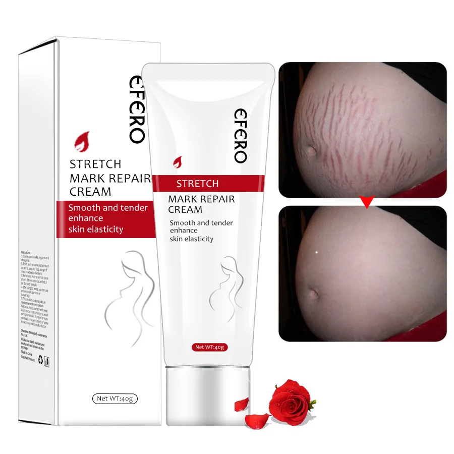 Pregnant Women Stretch Marks Emulsion Pregnancy Cream Prenatal Postpartum Gestational Line Desalination Skin Oil |
