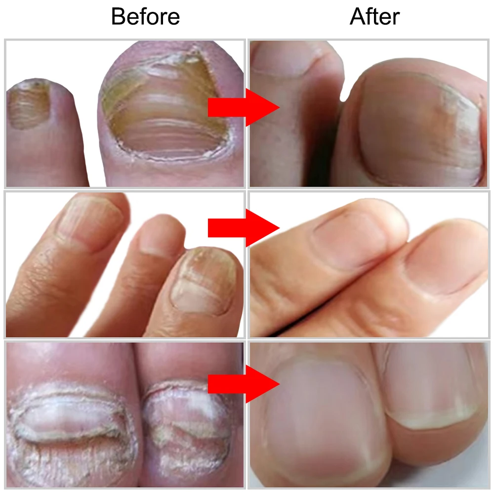 Грибковая Сыворотка для ногтей эссенция противоинфекции боронихия средство