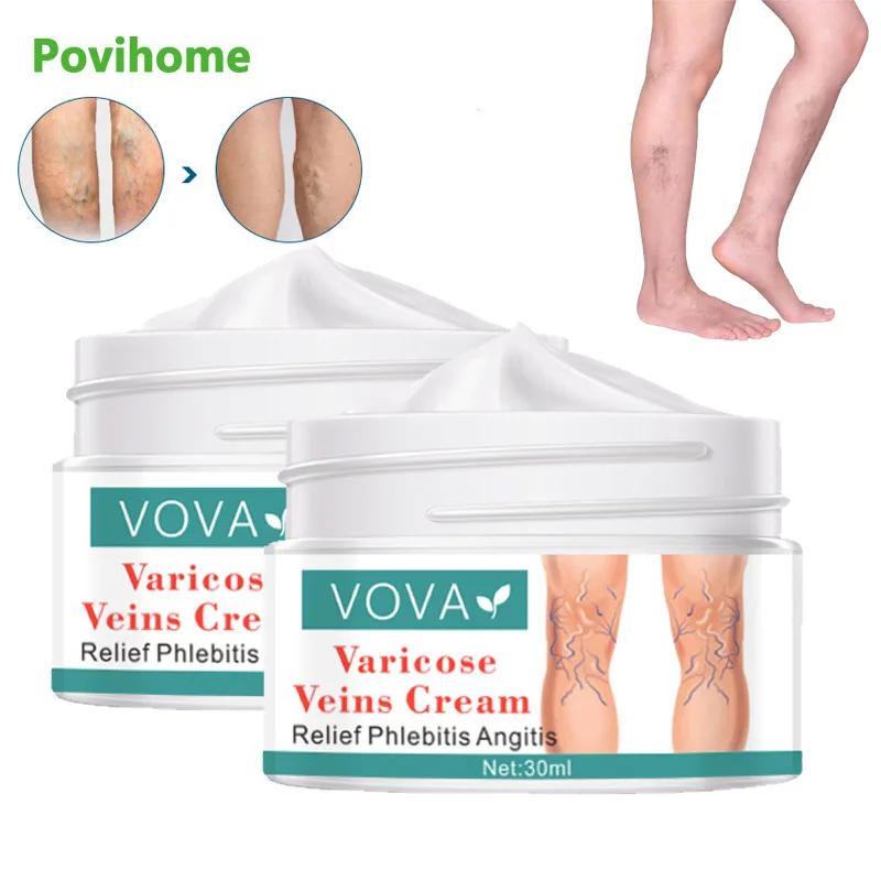 

1Pcs 30ml Original Varicose Veins Cream Treat Vasculitis Phlebitis Remove Spider Swelling Pain Relief Ointment Medical Plaster