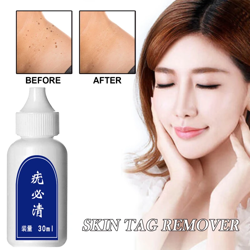 Средство для удаления бородавок 10 мл Моментальное Удаление родинок и папилломы