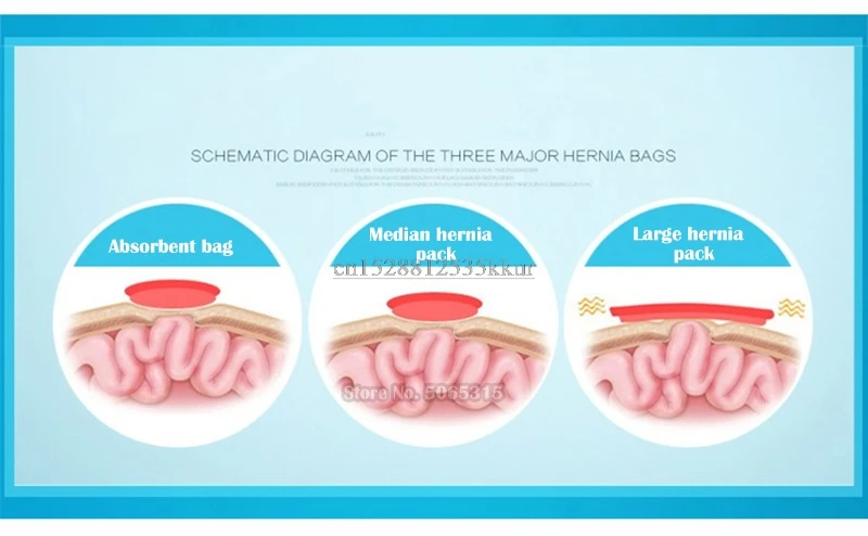 Продукты высокого качества бесплатная доставка детская пупочная грыжа с