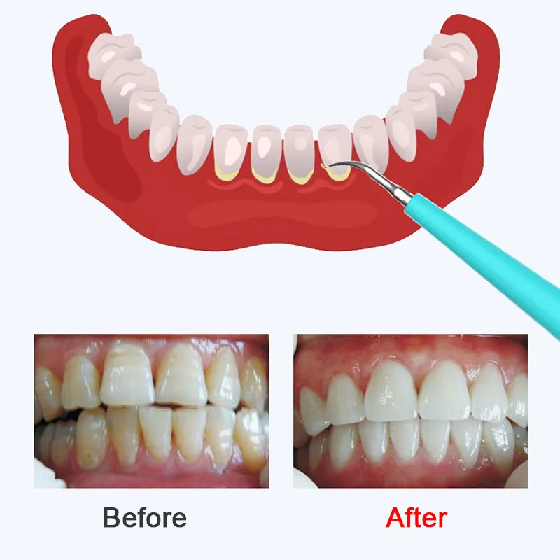 Электрический зубной аппарат для удаления пятен зубного налета Sonic Dental Scaler USB