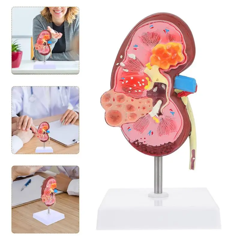 

1pc Human Kidney Pathological Model Human Body Model Teaching Demonstration Display Model