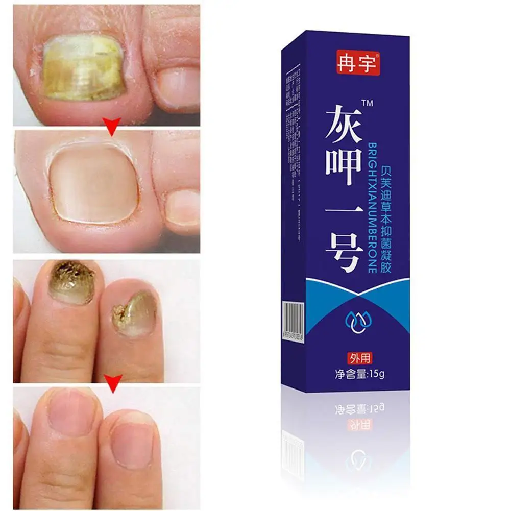 

1Pcs Antibacterial Chinese Natural Herbal Cream Nail Onychomycosis Cream Nails Toes Repair Gel Fungus Toes Anti Infection Cream